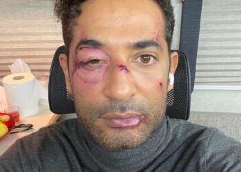 “عمرو سعد” يظهر بكدمات على وجهه !
