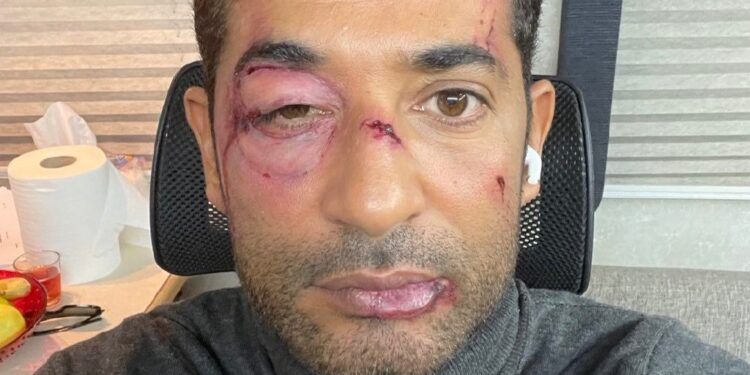 “عمرو سعد” يظهر بكدمات على وجهه !